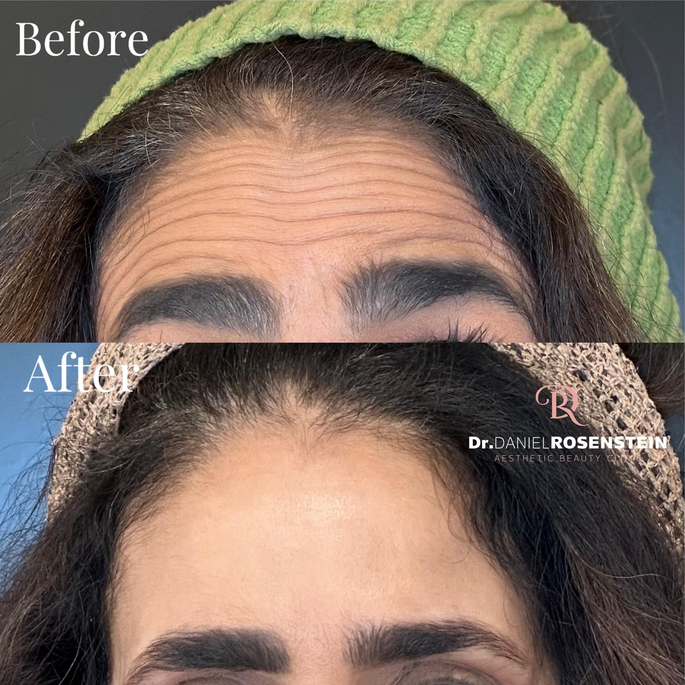 הרפיית קמטי מצח — לפני ואחרי